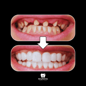 การทำ รากฟันเทียม แก้ปัญหาอะไรได้บ้าง