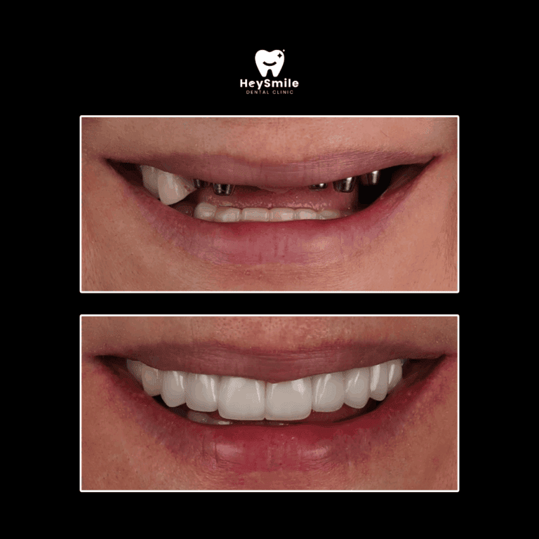 ทำไม รากฟันเทียม ถึงเป็นทางเลือกที่ดีที่สุด