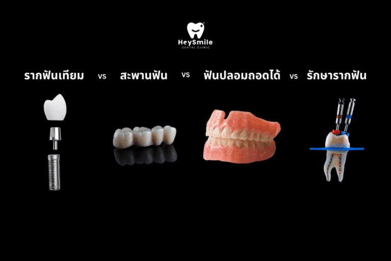 ระหว่าง รากฟันเทียม สะพานฟัน ฟันปลอมถอดได้ และ รักษารากฟัน แบบไหนดีกว่า