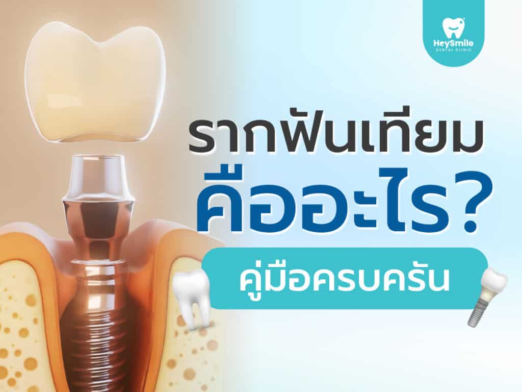 รากฟันเทียม คืออะไร