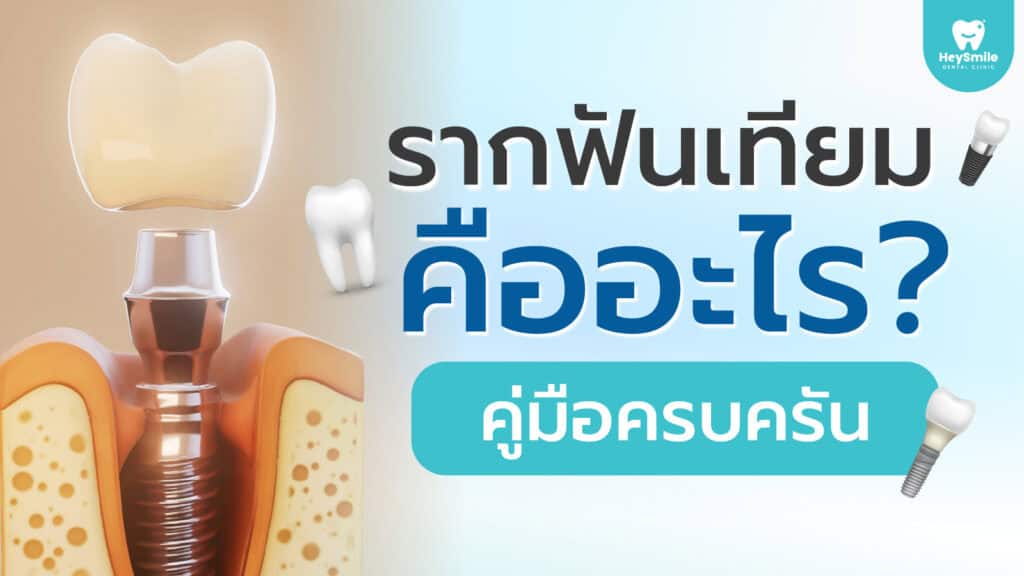 รากฟันเทียม คืออะไร