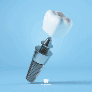 ส่วนประกอบของ รากฟันเทียม