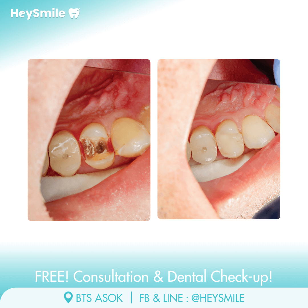 HeySmile Dental Clinic Root Canal Treatment #3