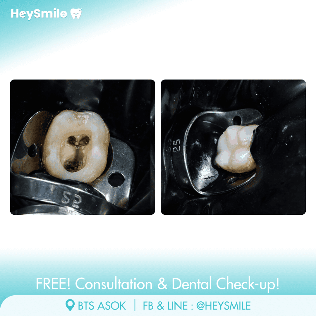 HeySmile Dental Clinic Root Canal Treatment #4