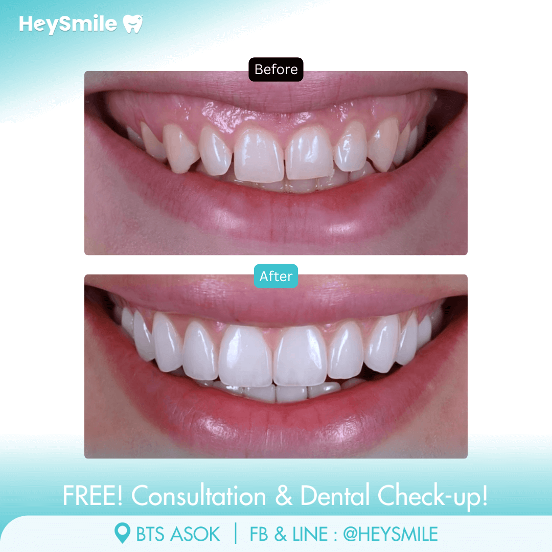 HeySmile Dental Clinic Veneers #1