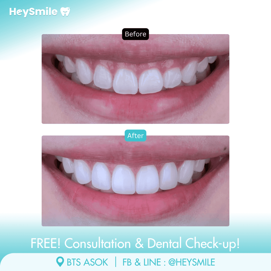 HeySmile Dental Clinic Veneers #10