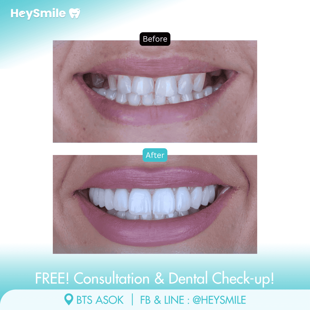 HeySmile Dental Clinic Veneers #11