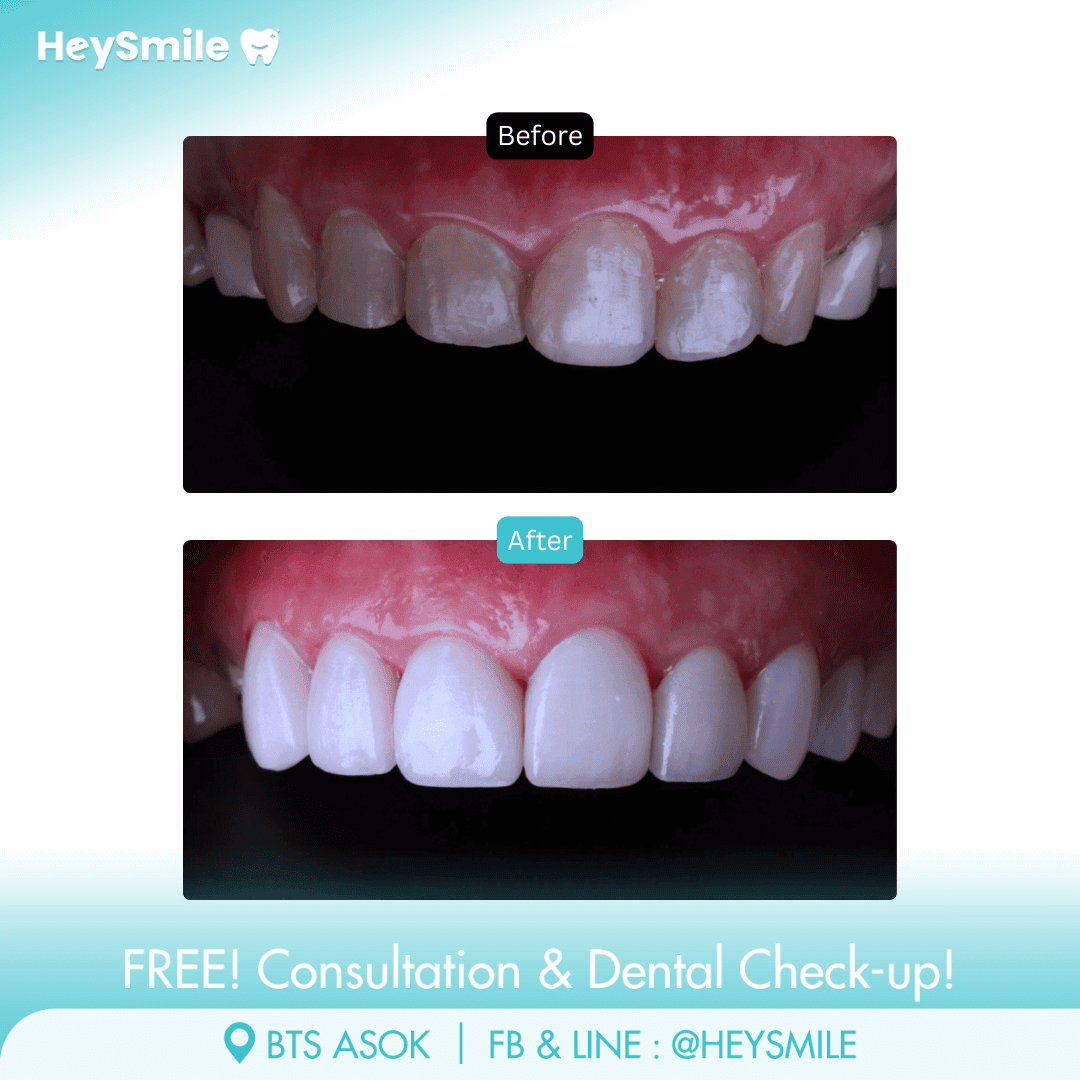 HeySmile Dental Clinic Veneers #2