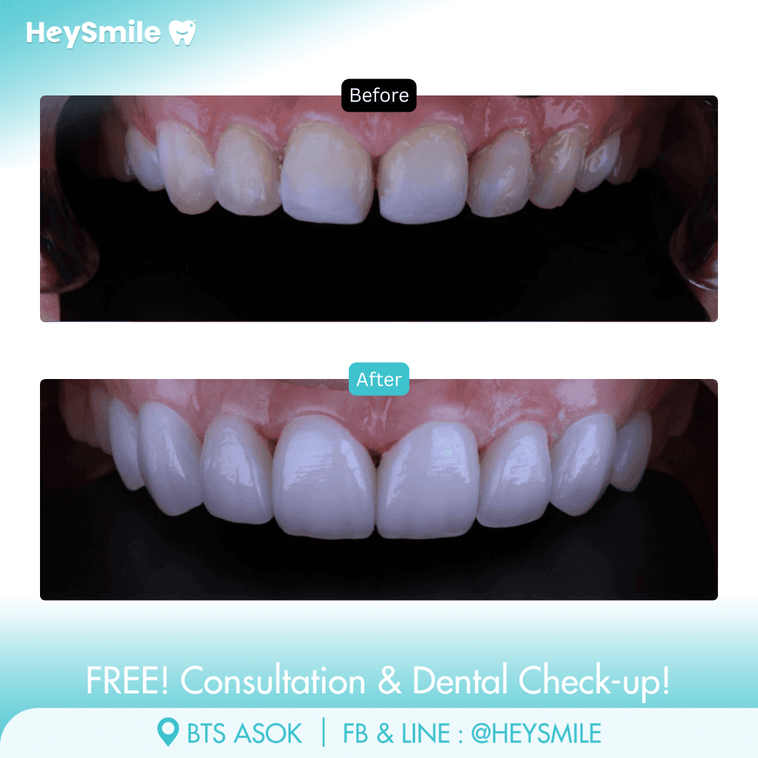HeySmile Dental Clinic Veneers #3