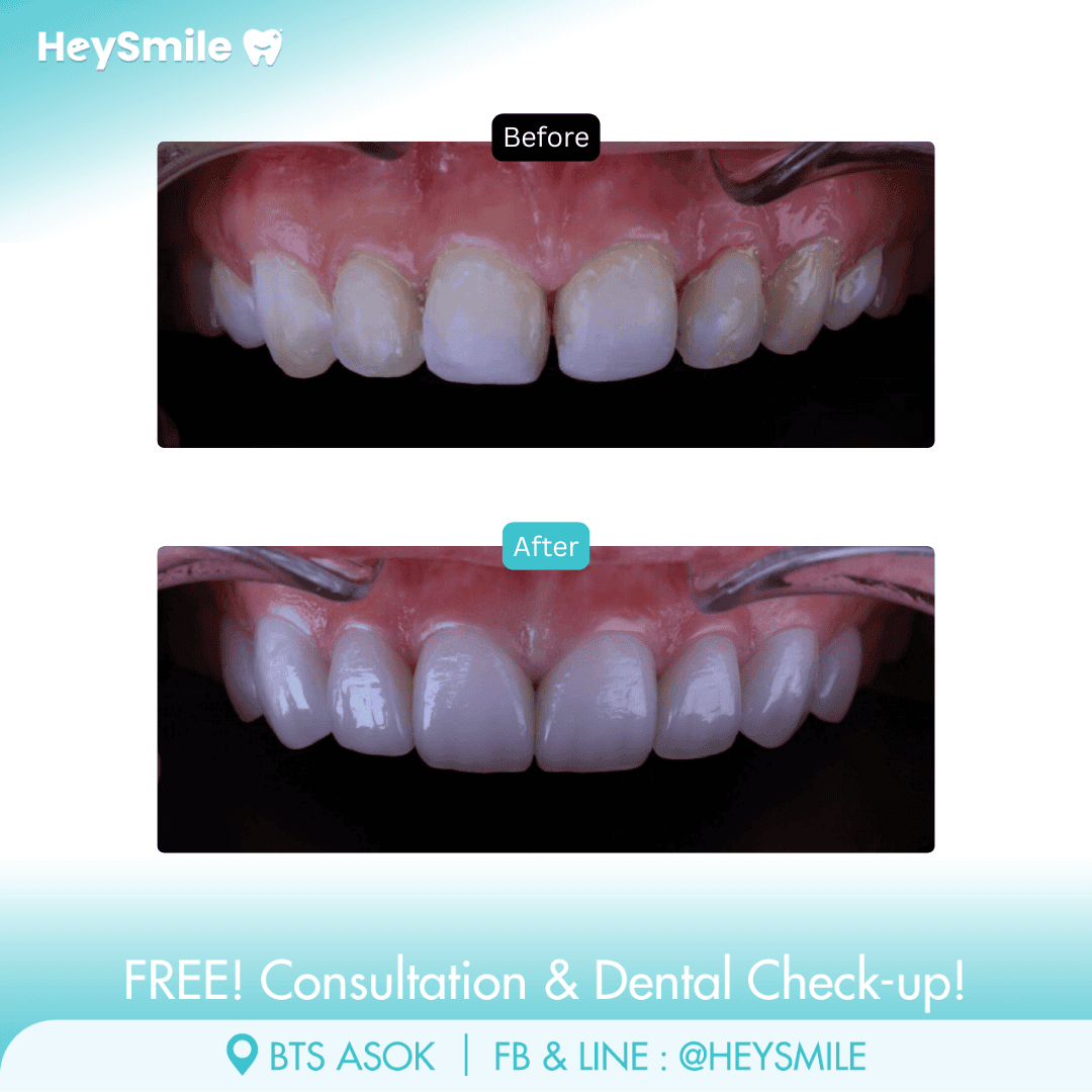 HeySmile Dental Clinic Veneers #4
