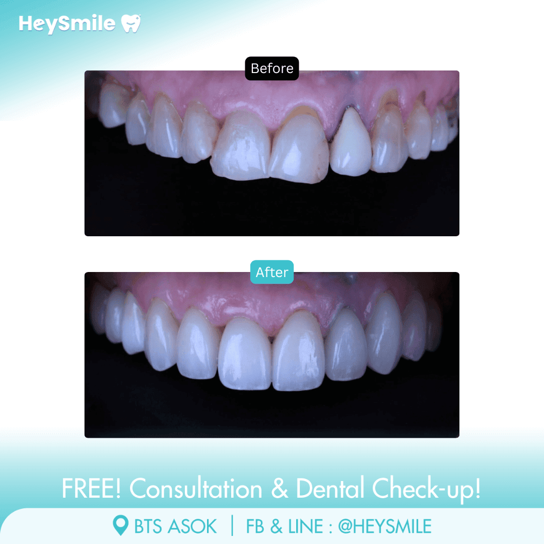 HeySmile Dental Clinic Veneers #5