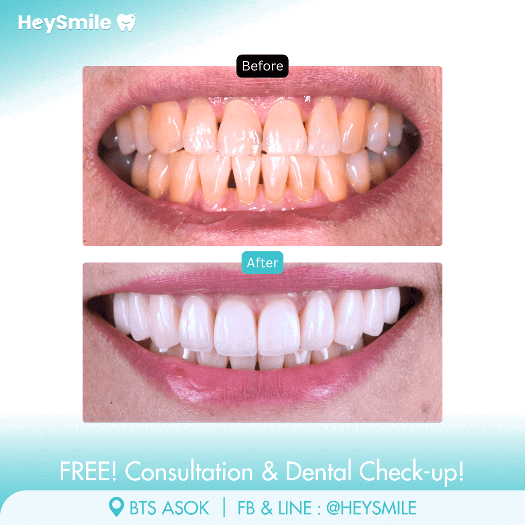 HeySmile Dental Clinic Veneers #6