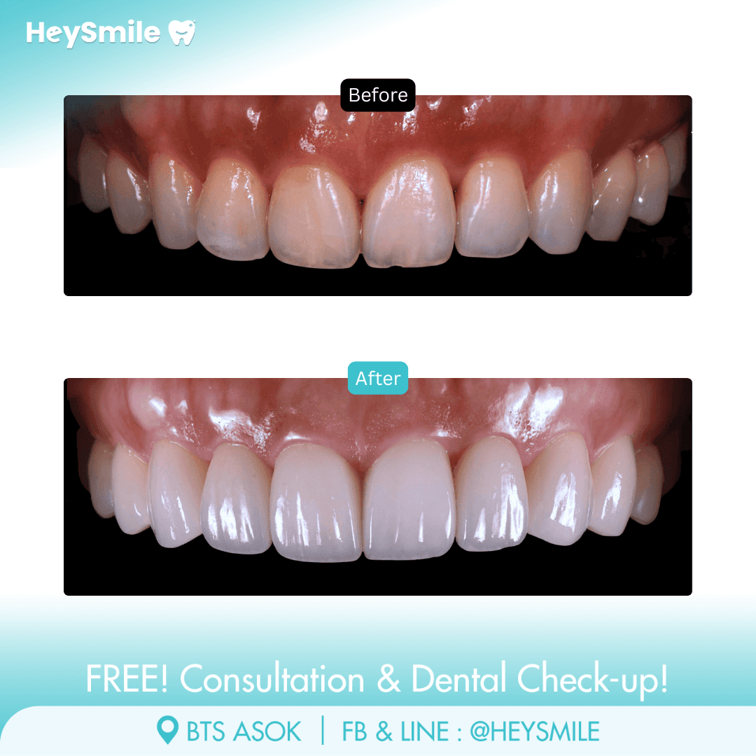 HeySmile Dental Clinic Veneers #7