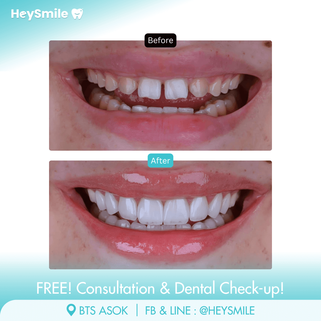 HeySmile Dental Clinic Veneers #8