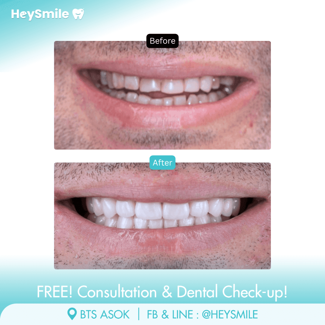 HeySmile Dental Clinic Veneers #9