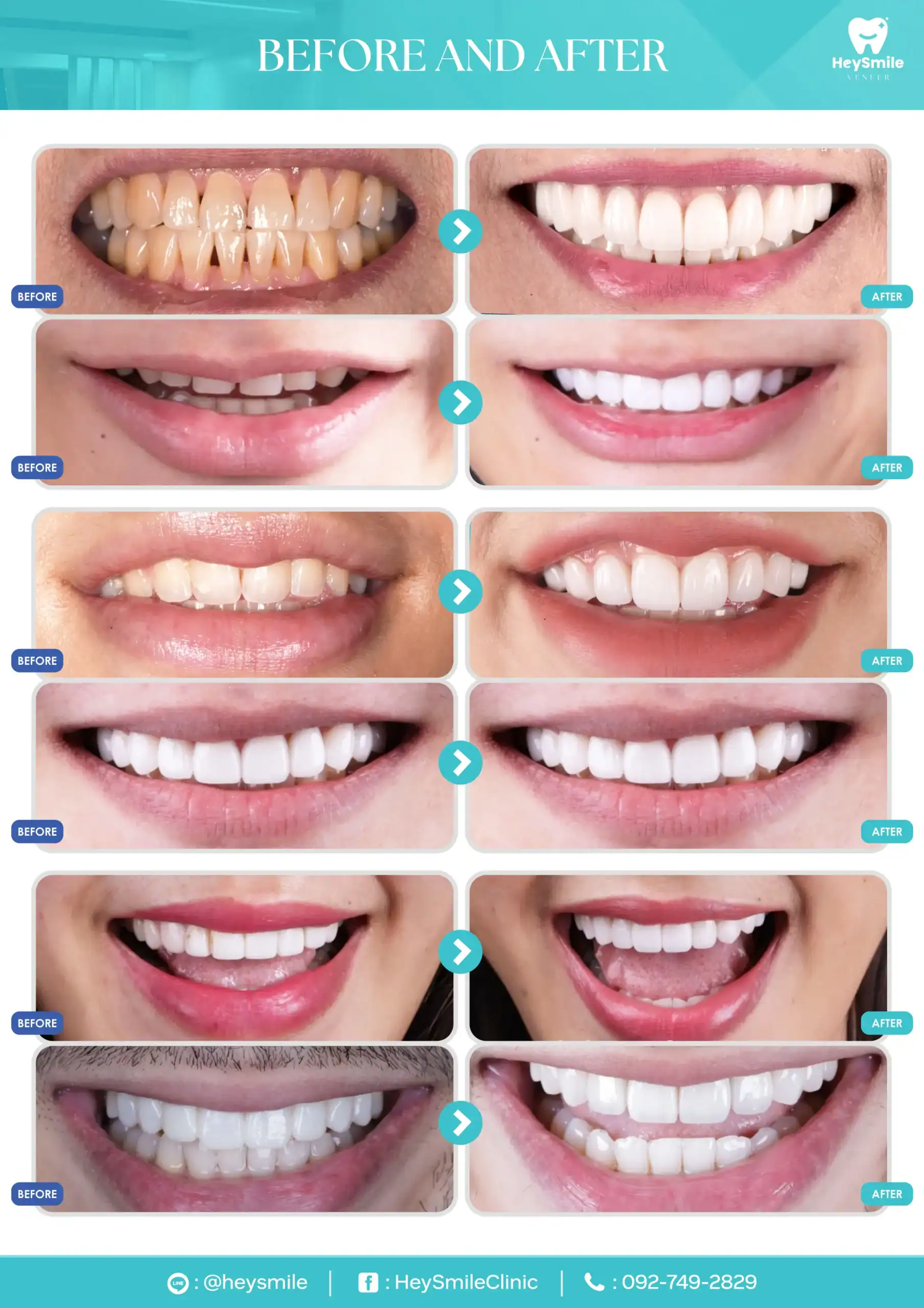 Why Choose Dental Veneers