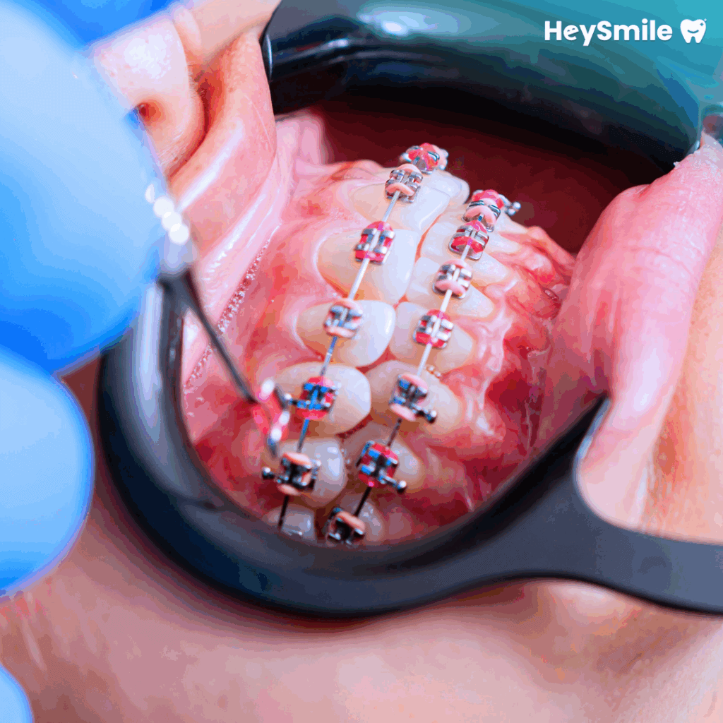 Appliance Placement First Aligner Set (1)
