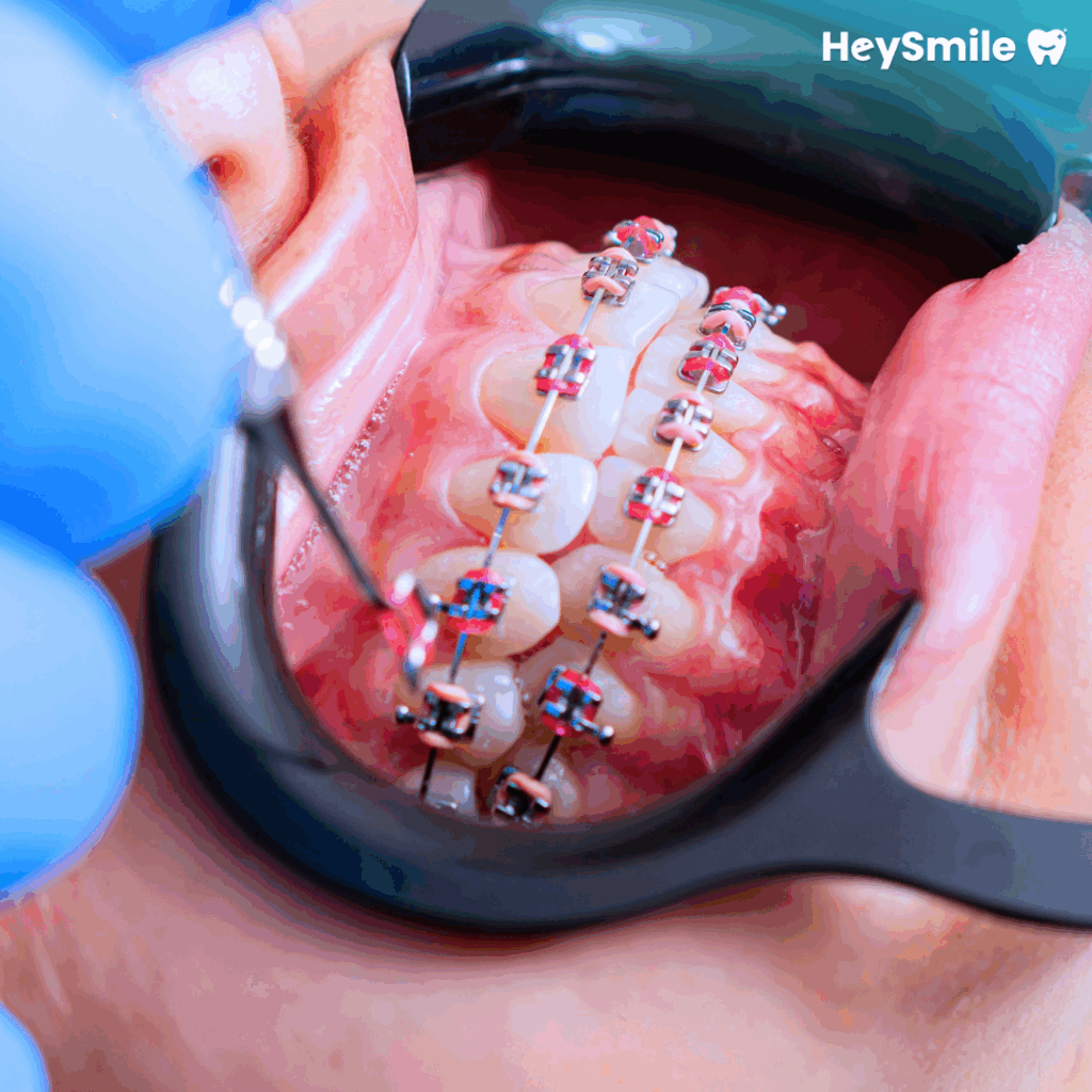 Appliance Placement First Aligner Set (1)