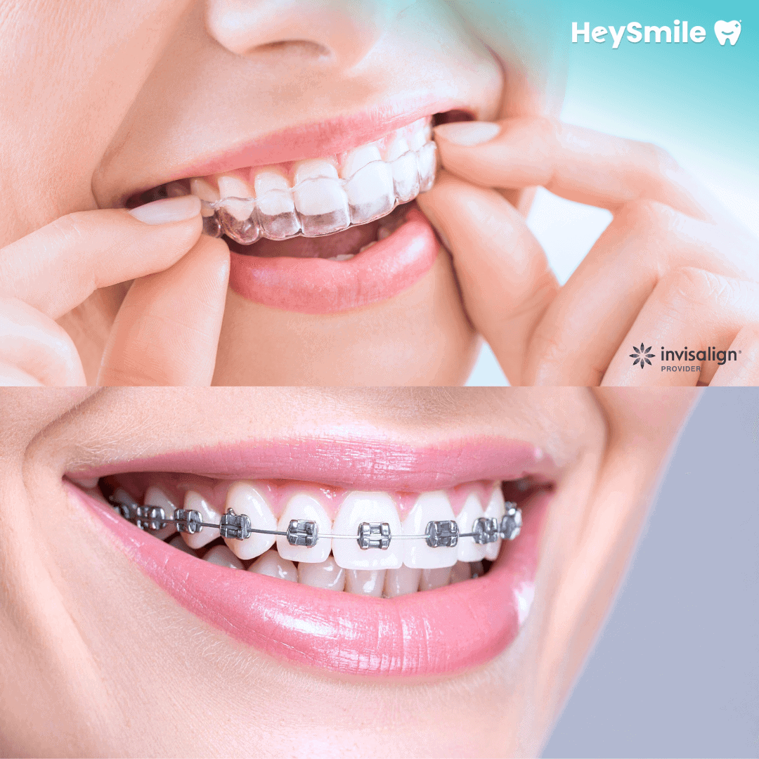 Premium Bracket Systems & Aligners