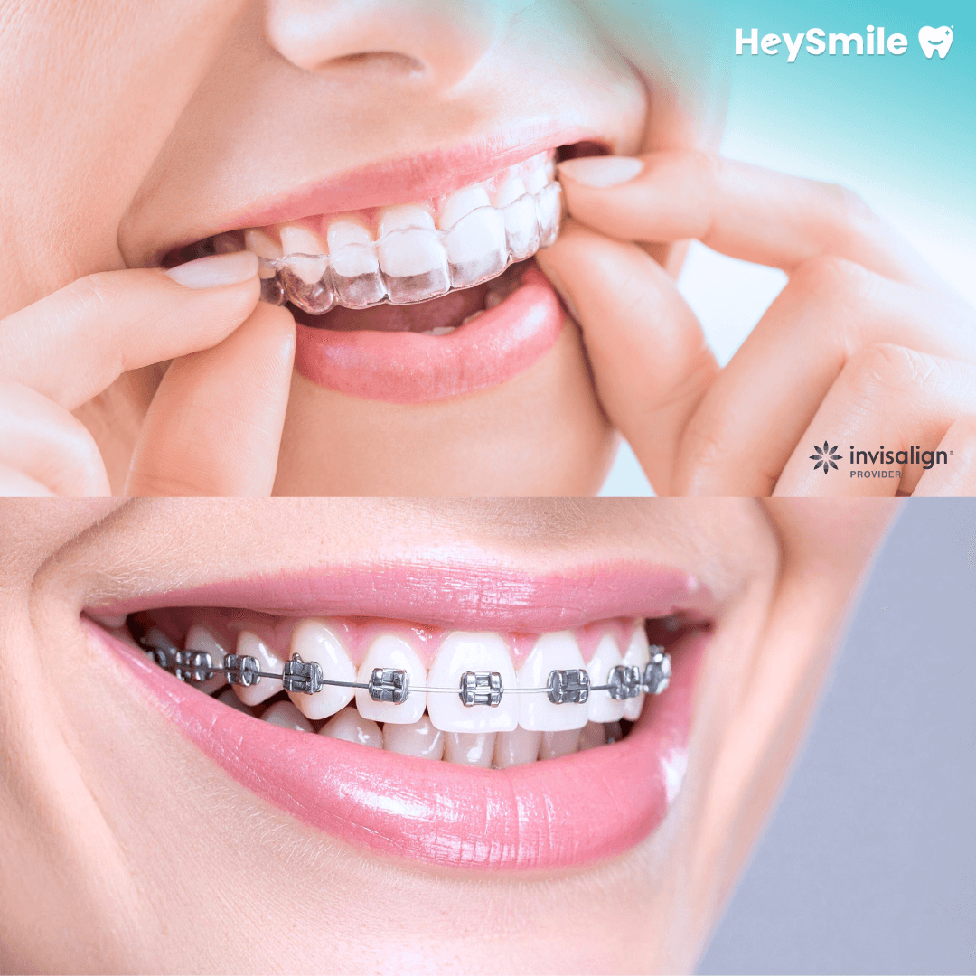 Premium Bracket Systems & Aligners