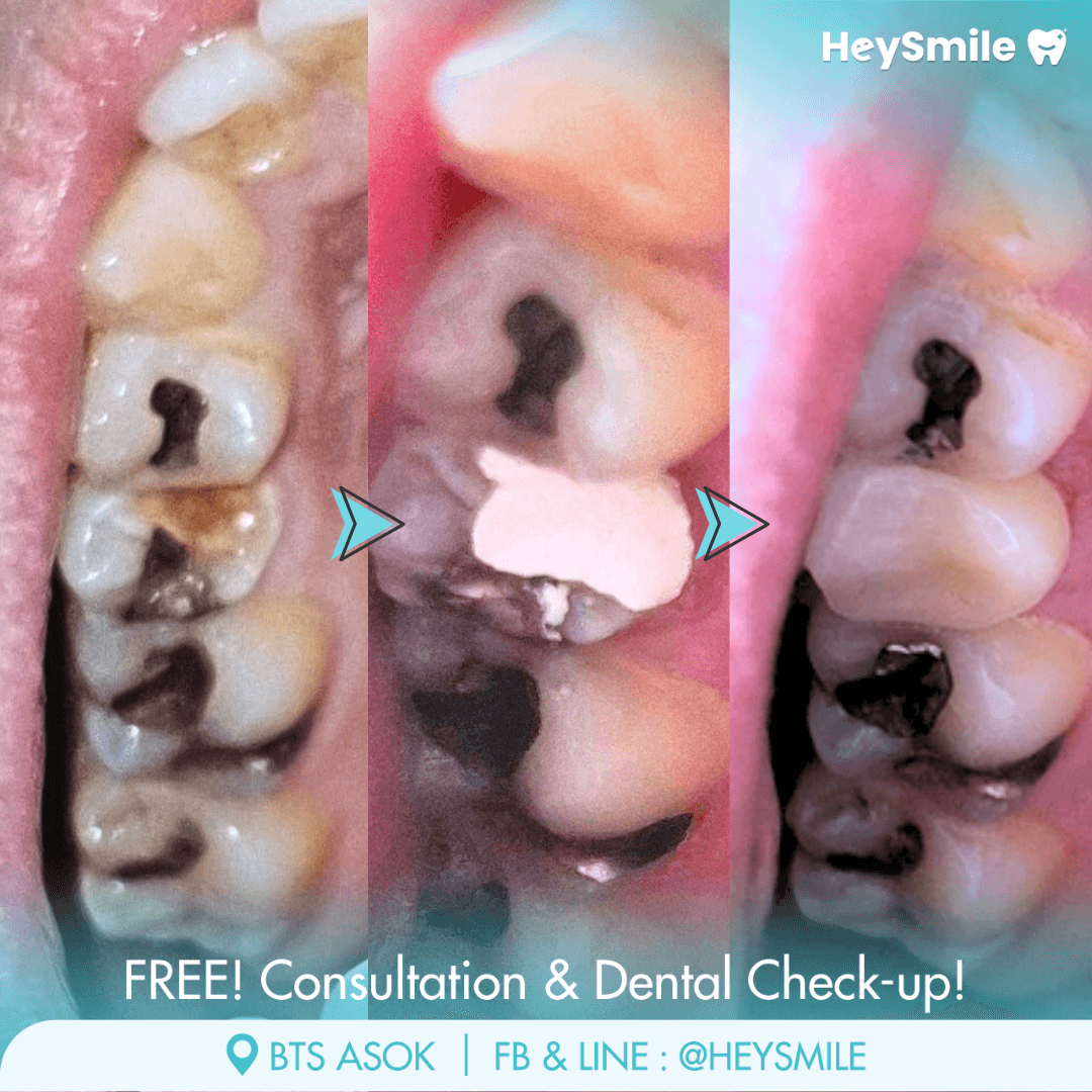 Restoration with Filling or Crown