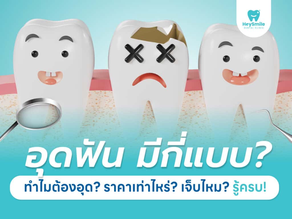 อุดฟัน มีกี่แบบ ทำไมต้องอุด