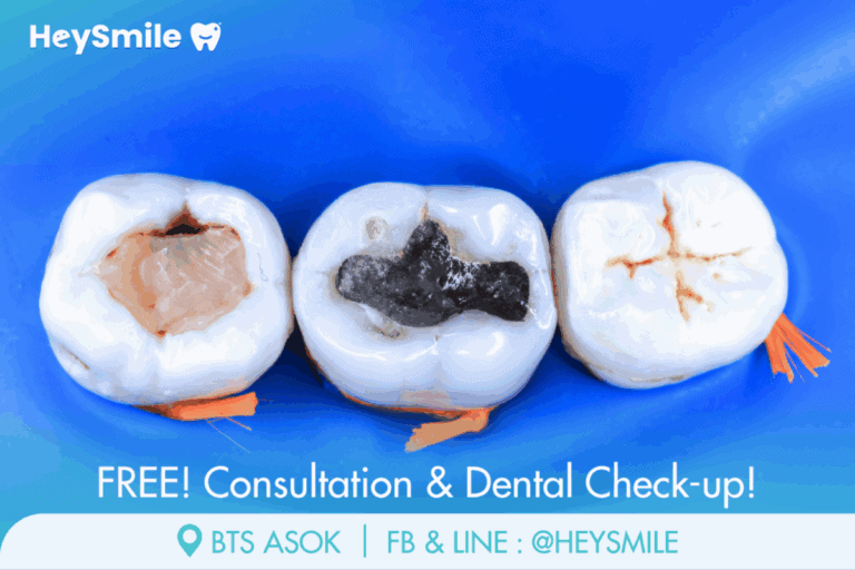 อุดฟัน สำคัญต่อสุขภาพช่องปากอย่างไร ป้องกันปัญหาฟันลุกลาม