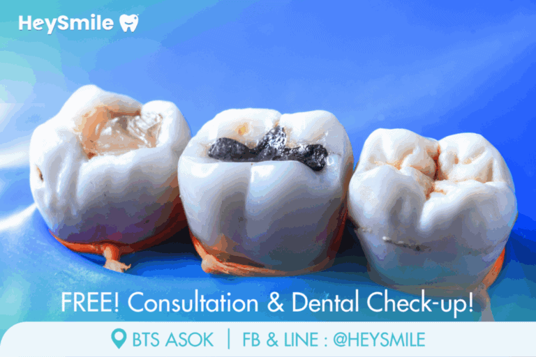 เลือก อุดฟัน แบบไหนดีที่สุด