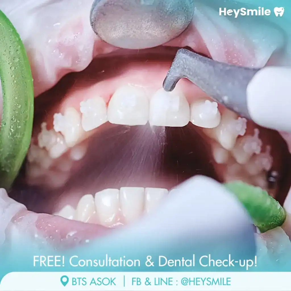 AirFlow Polishing (Optional Upgrade)