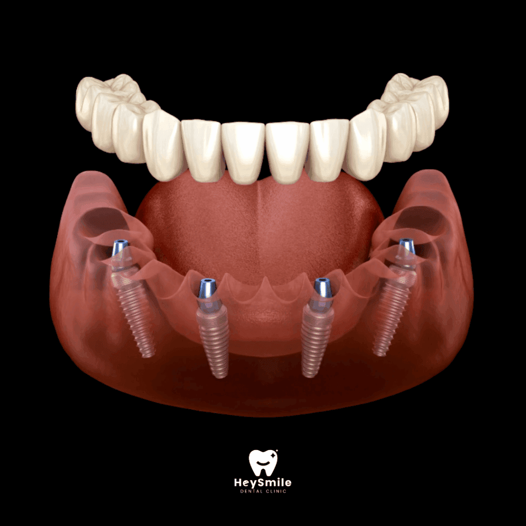 All on 4® ProArch Dental Implants