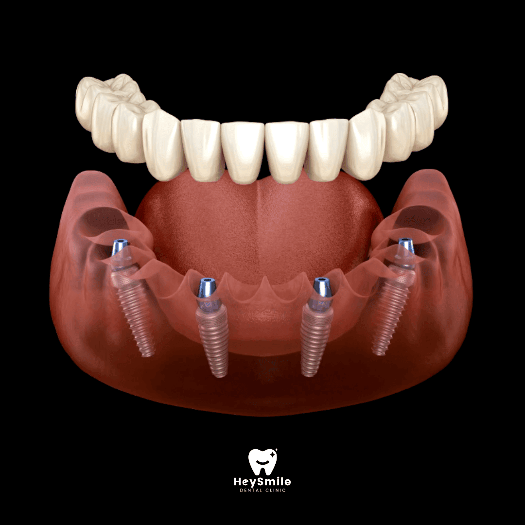 All on 4® ProArch Dental Implants
