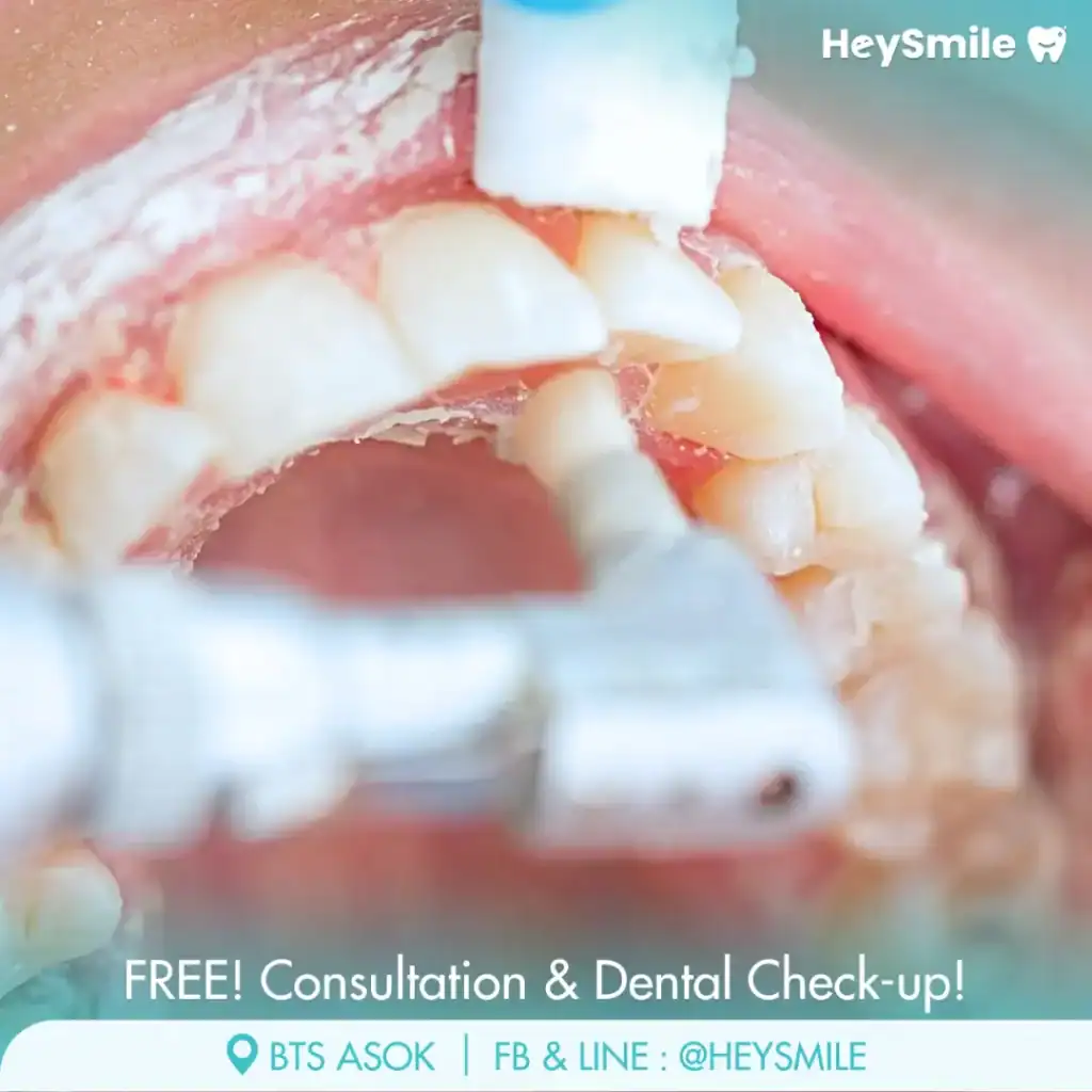 Fluoride Treatment & Aftercare