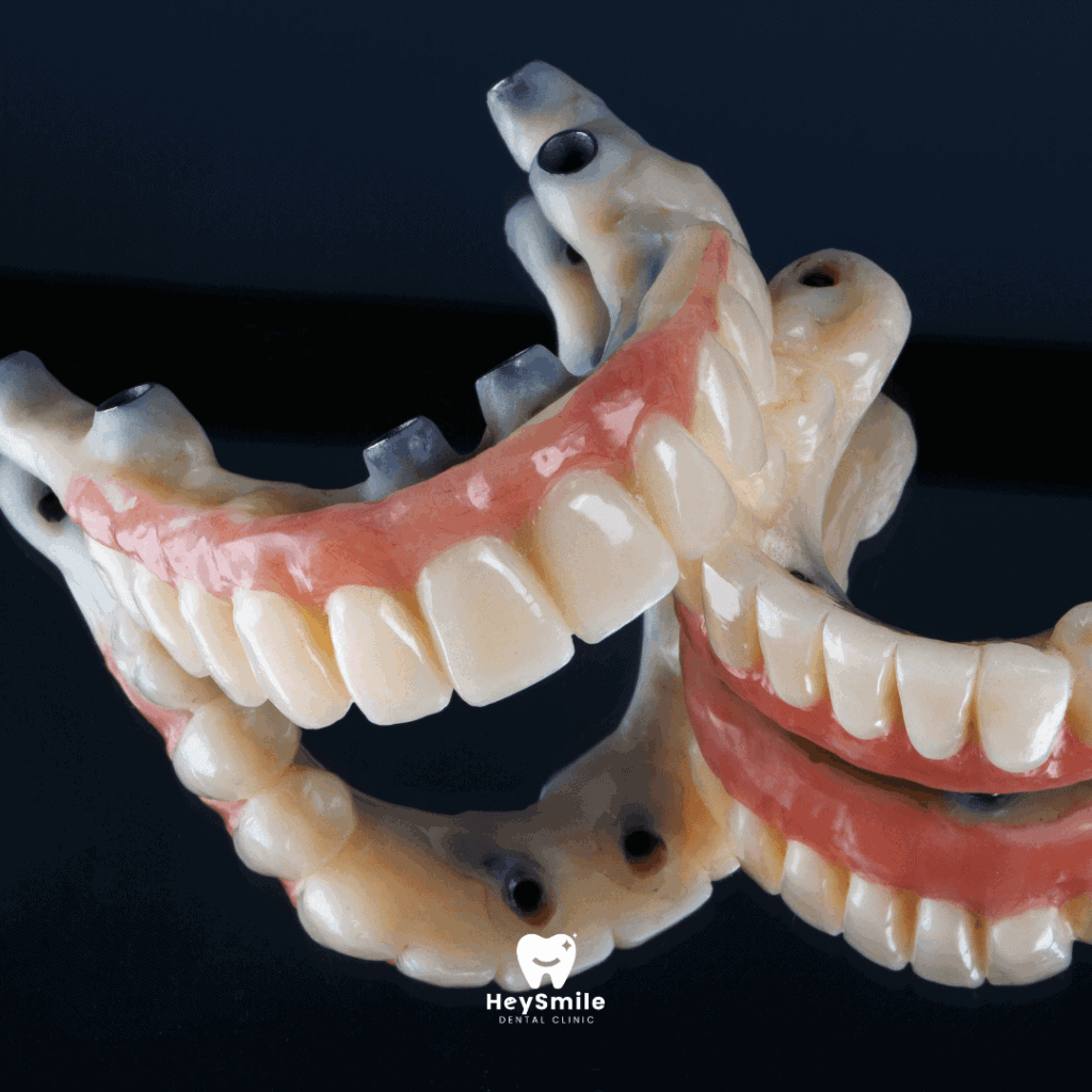 Full Arch Missing Teeth
