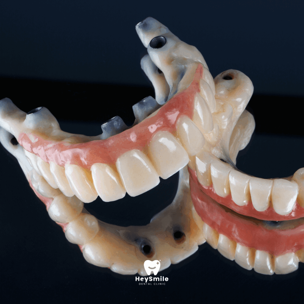 Full Arch Missing Teeth