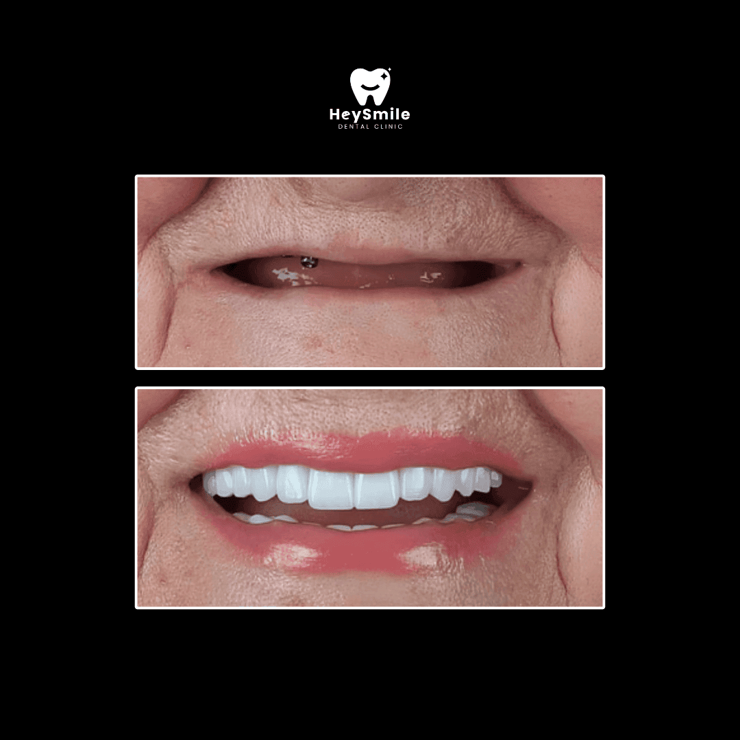 Full Dental Implant Bridges (1)