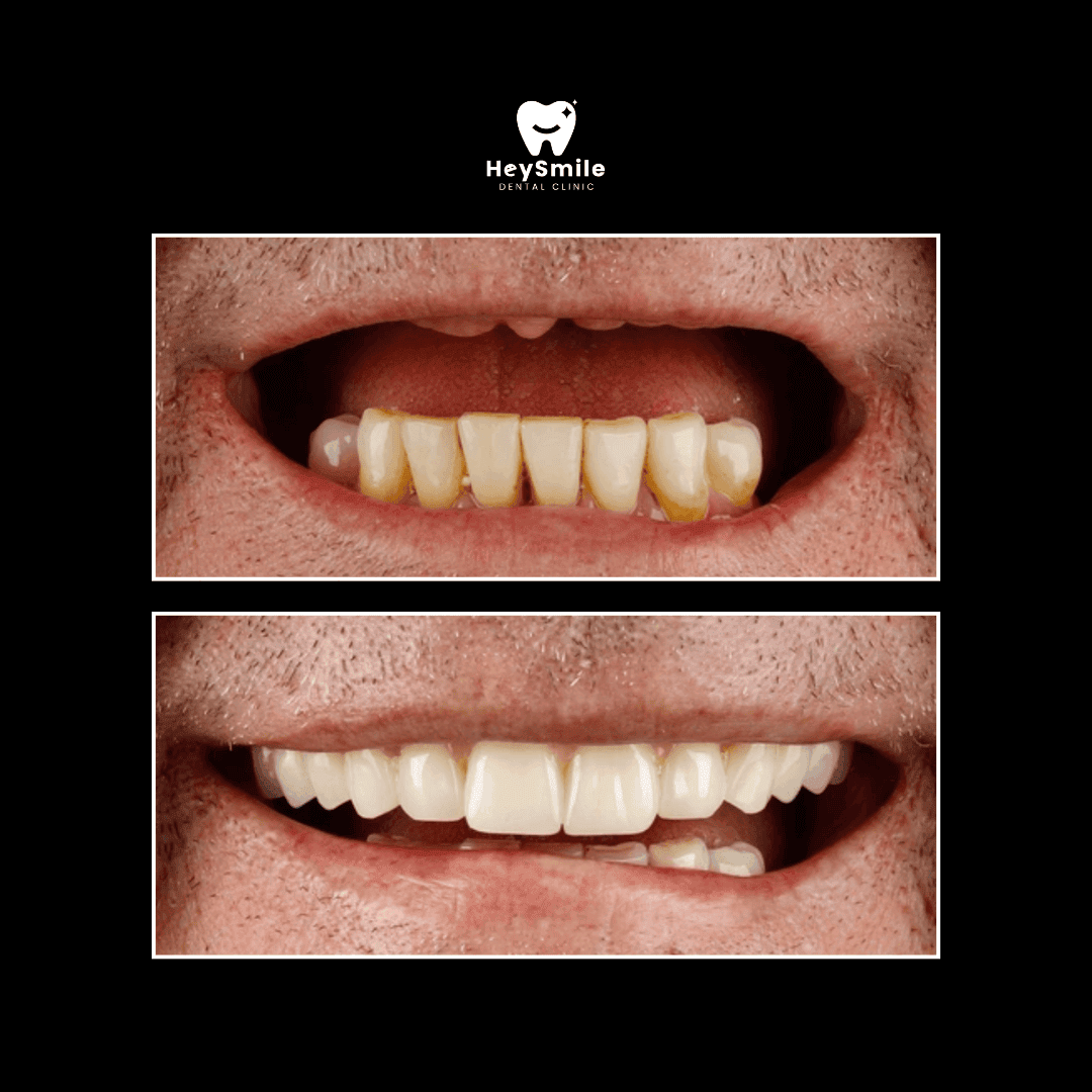 Full Dental Implant Bridges (2)