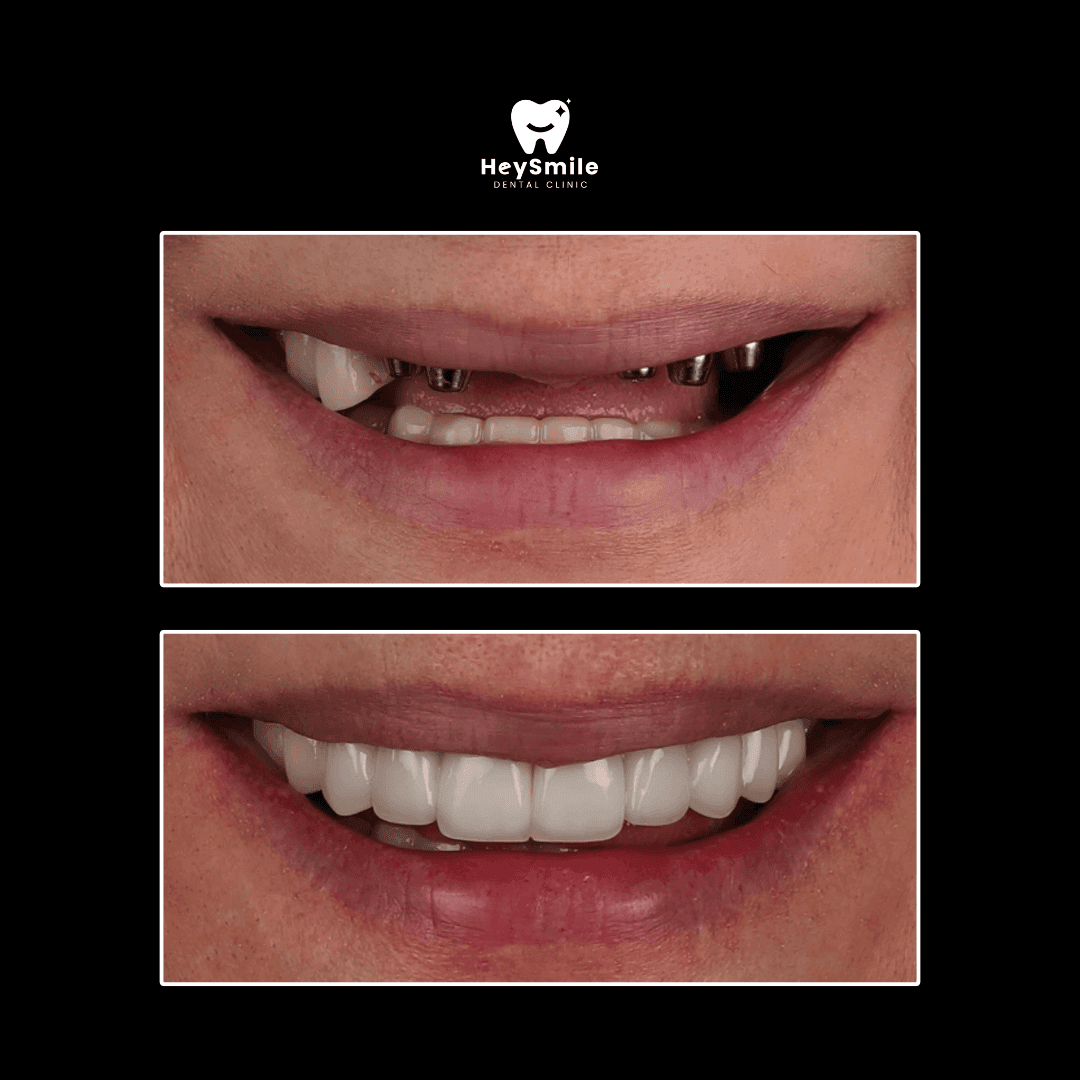 Full Dental Implant Bridges (3)