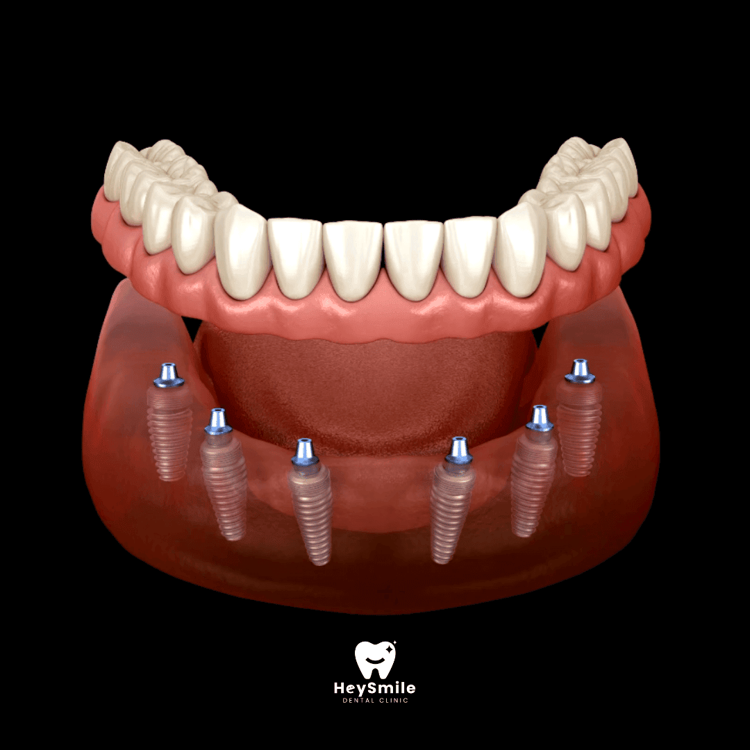 Full Dental Implant Bridges