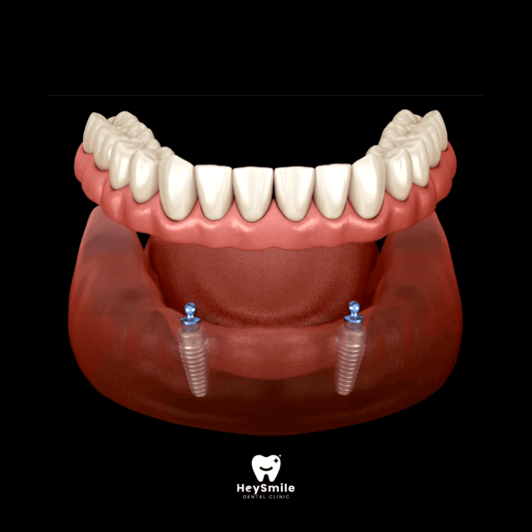 Implant Supported Overdentures