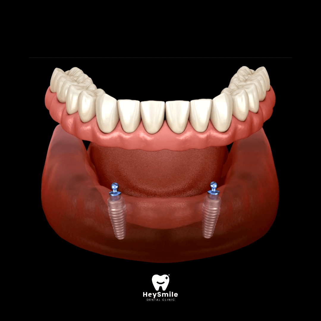 Implant Supported Overdentures