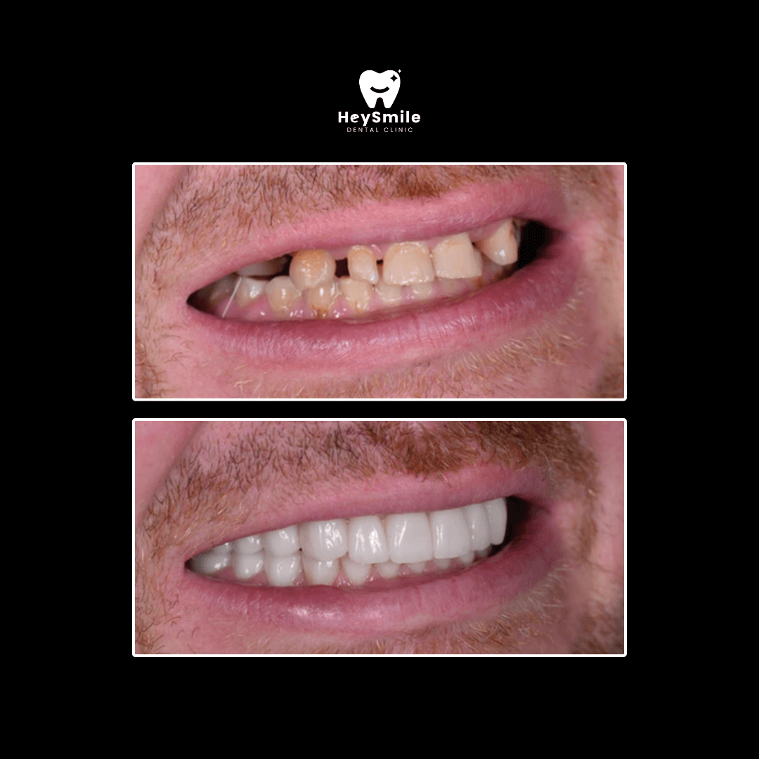 Multiple Missing Teeth (1)