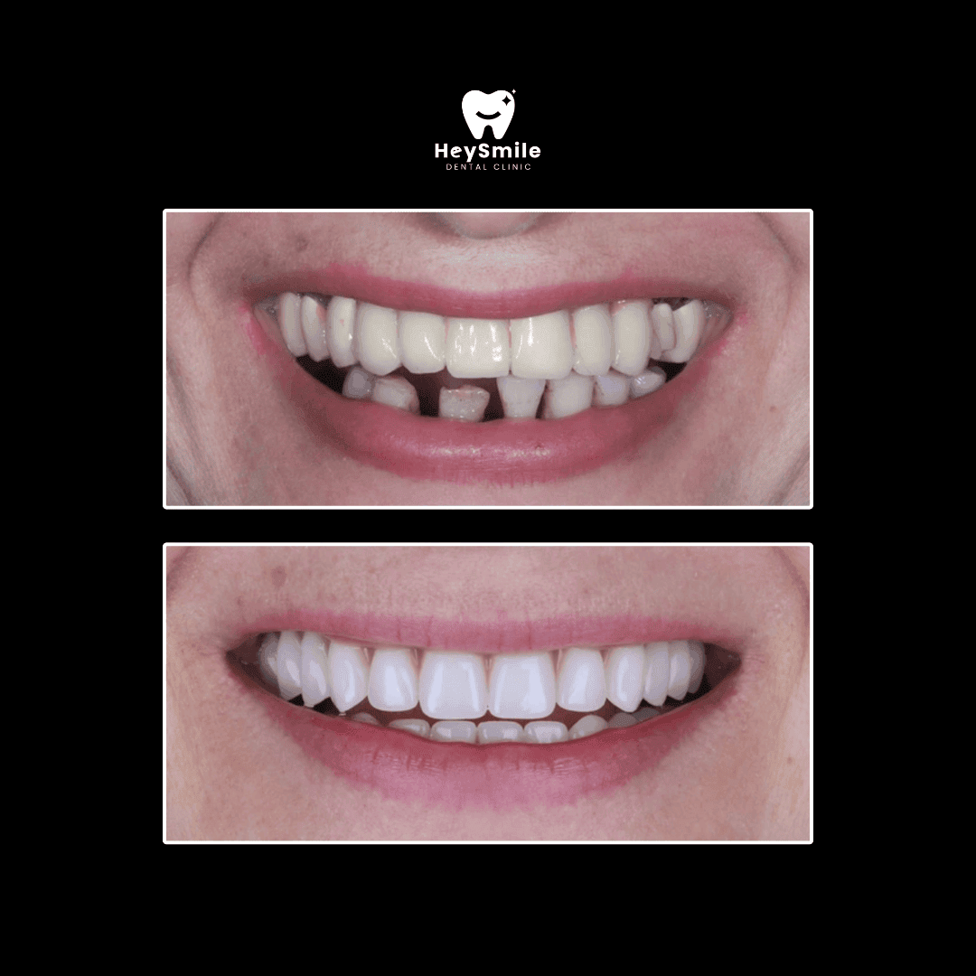 Multiple Missing Teeth (2)
