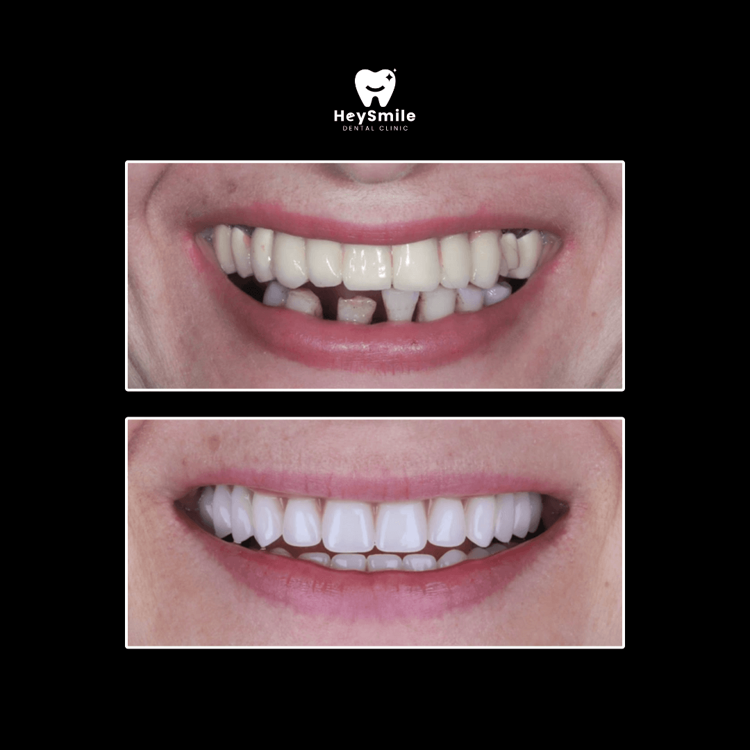 Multiple Missing Teeth (2)