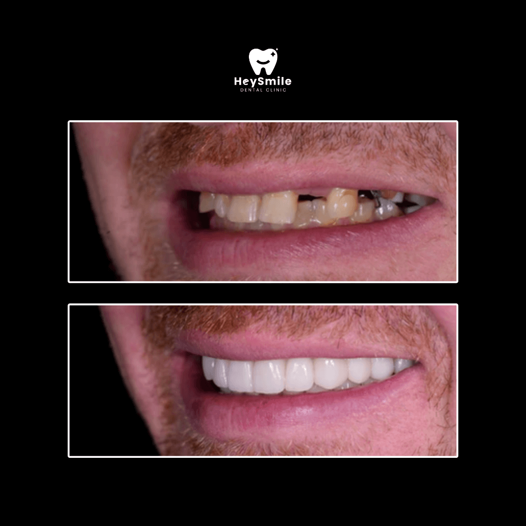 Multiple Missing Teeth (3)