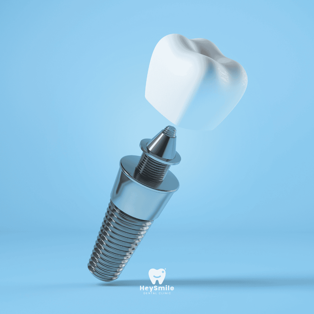 ส่วนประกอบของ รากฟันเทียม