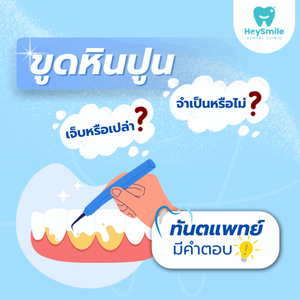 ขูดหินปูน