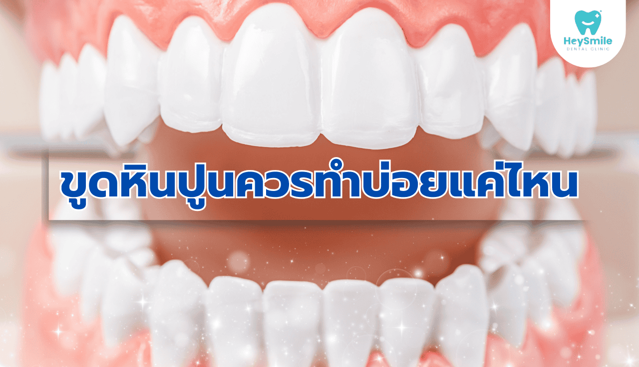 ขูดหินปูน