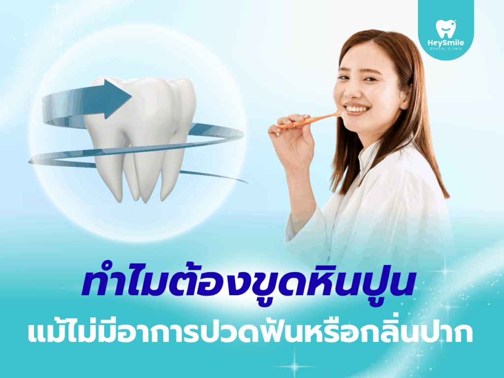 ขูดหินปูน