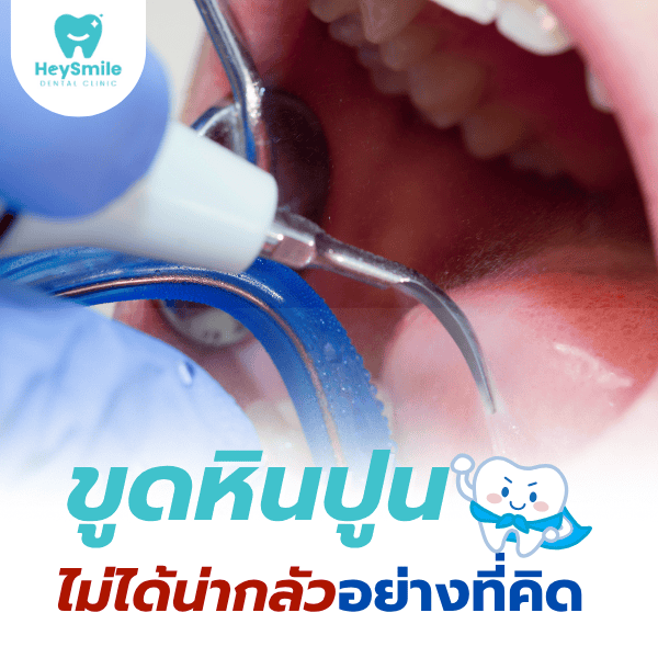 ขูดหินปูน