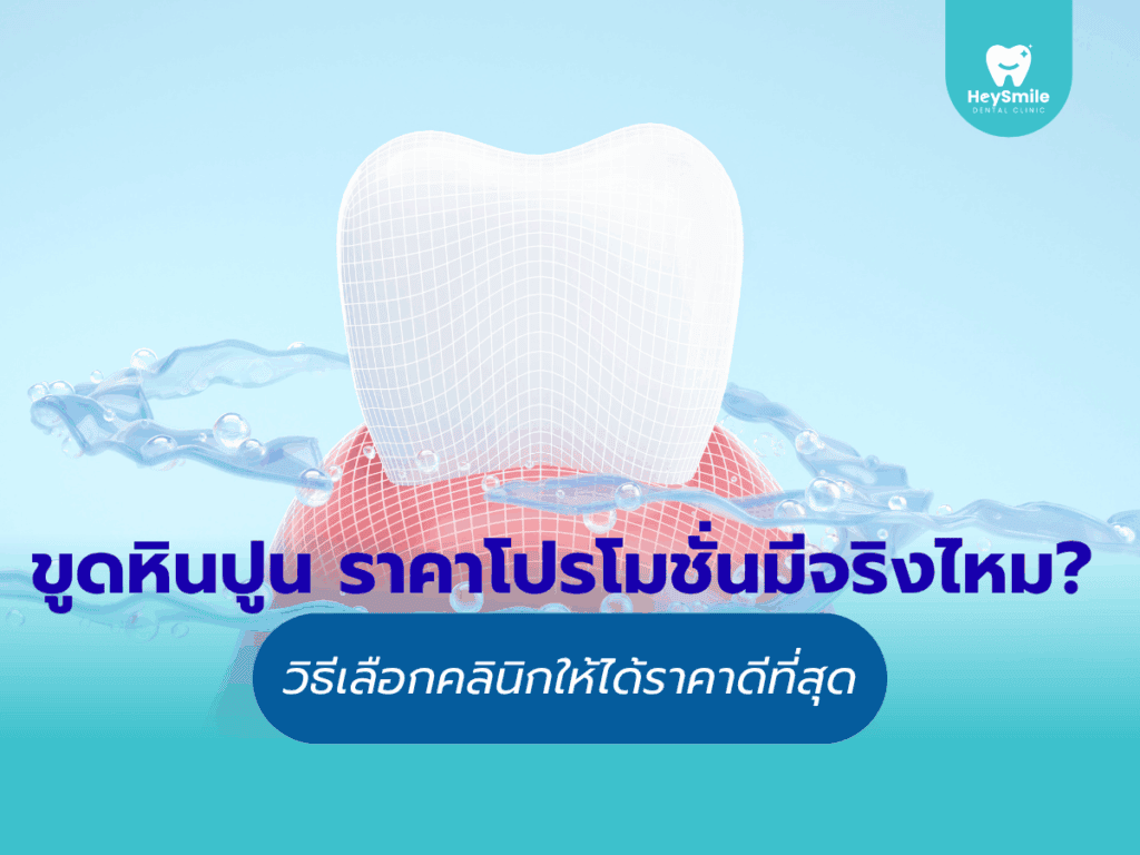 ขูดหินปูน